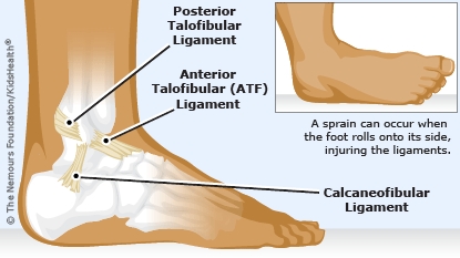 Ankle Sprains