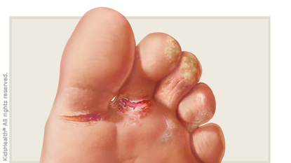 Athletes Foot