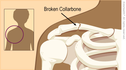Broken Collarbone (Clavicle Fracture)