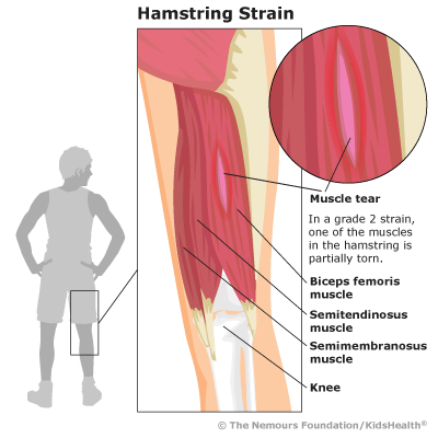 Hamstring Strain