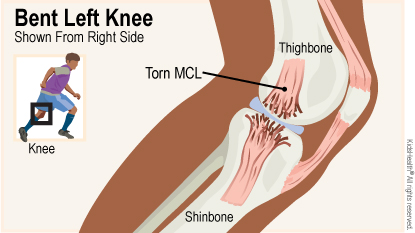 Medial Collateral Ligament (MCL) Injuries