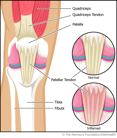 Jumpers Knee