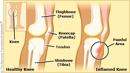 Osgood-Schlatter Disease