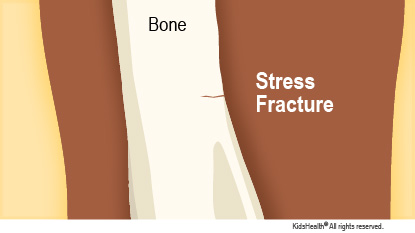 Stress Fractures