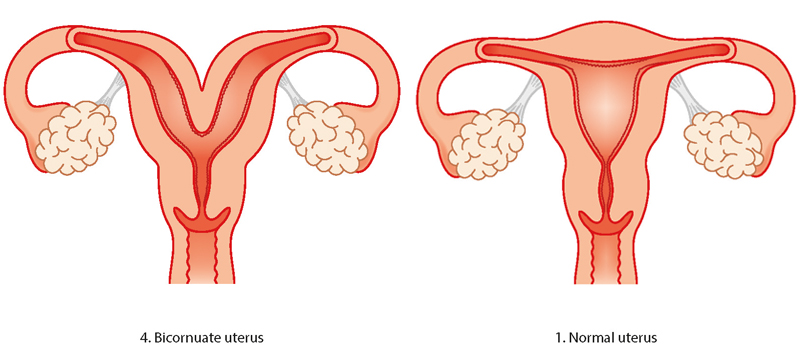 Uterine abnormality - problems with the womb