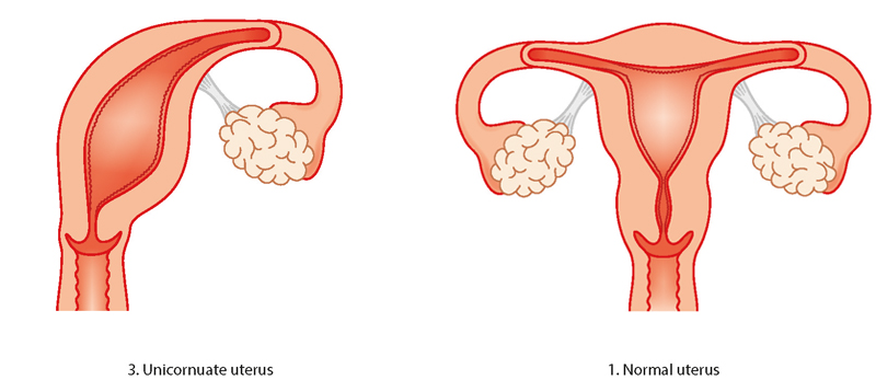 Uterine abnormality - problems with the womb