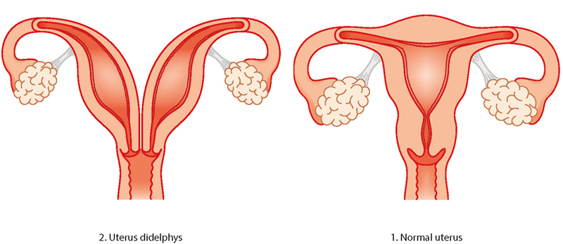 Uterine abnormality - problems with the womb