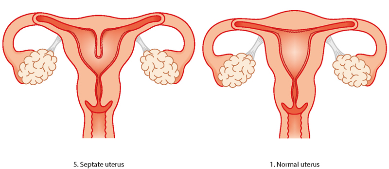Uterine abnormality - problems with the womb