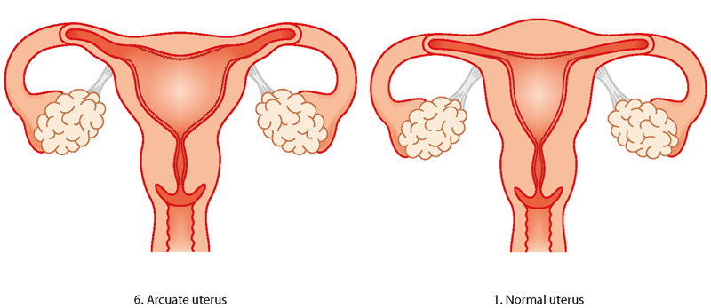 Uterine abnormality - problems with the womb