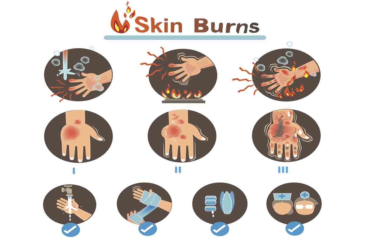 First Aid For Burns: How to Treat and Heal Every Type of Burn