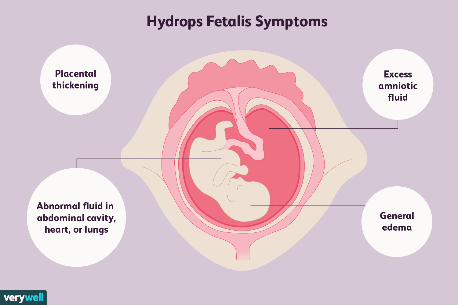 An Overview of Hydrops Fetalis